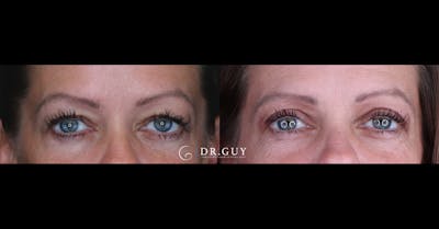 Upper Blepharoplasty Before & After Gallery - Patient 122923 - Image 1