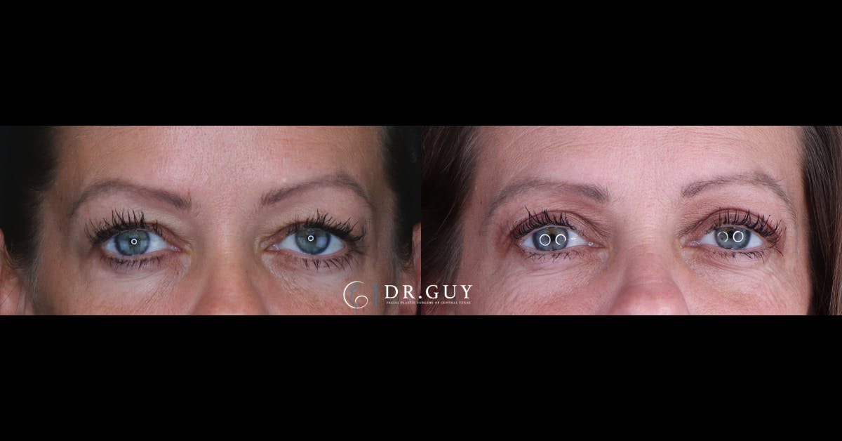 Upper Blepharoplasty Before & After Gallery - Patient 122923 - Image 1