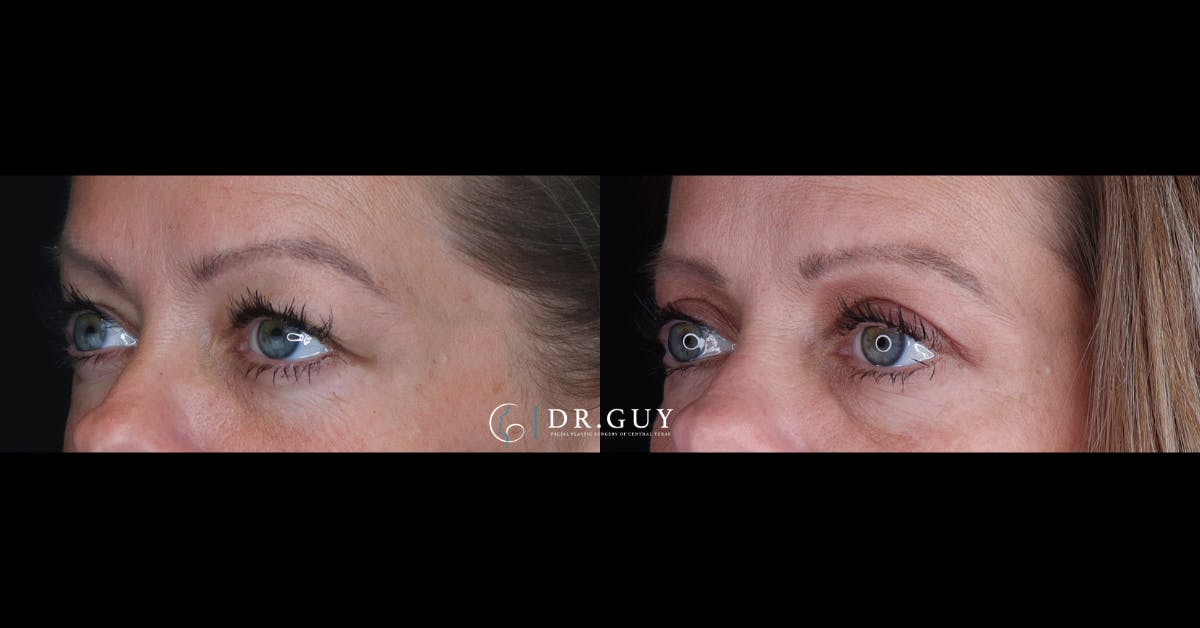 Upper Blepharoplasty Before & After Gallery - Patient 122923 - Image 2
