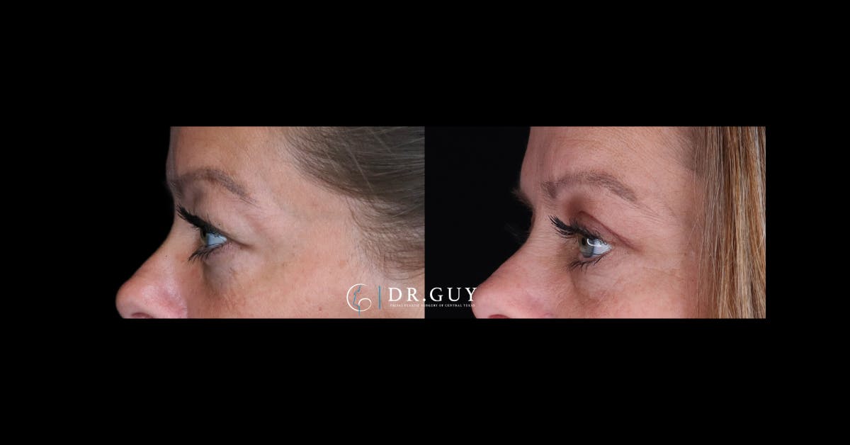 Upper Blepharoplasty Before & After Gallery - Patient 122923 - Image 3