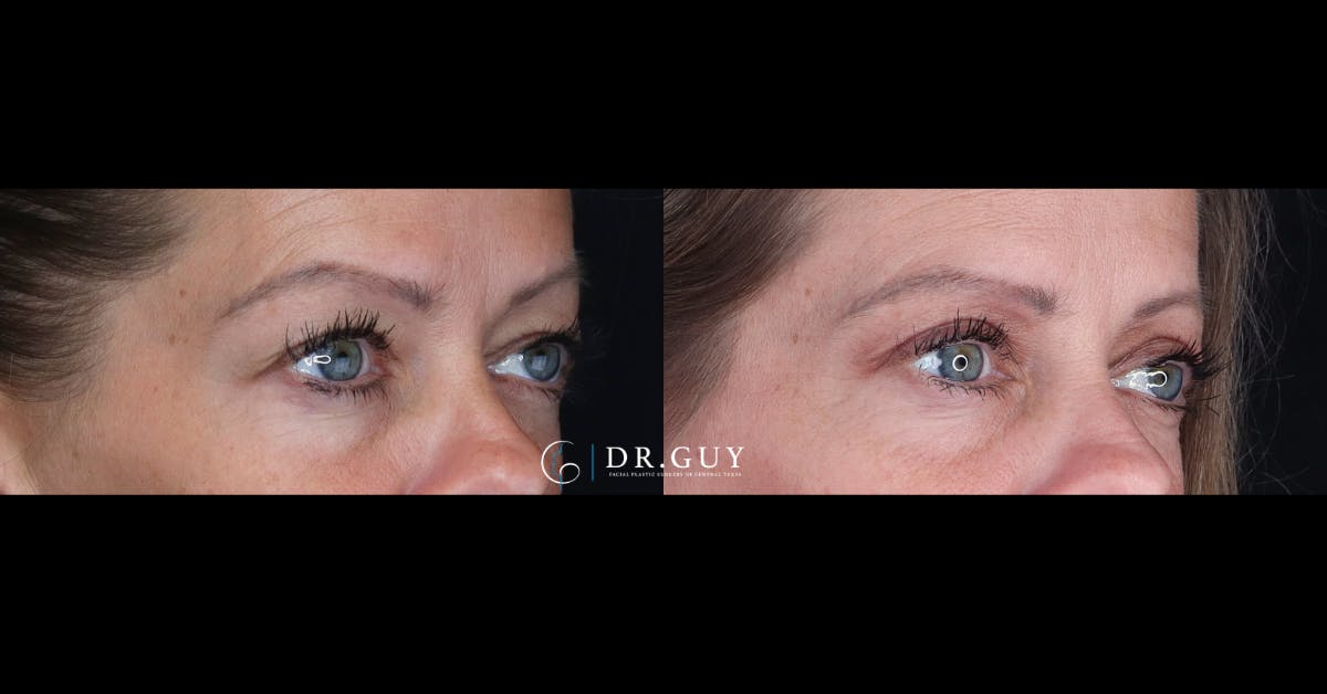 Upper Blepharoplasty Before & After Gallery - Patient 122923 - Image 4