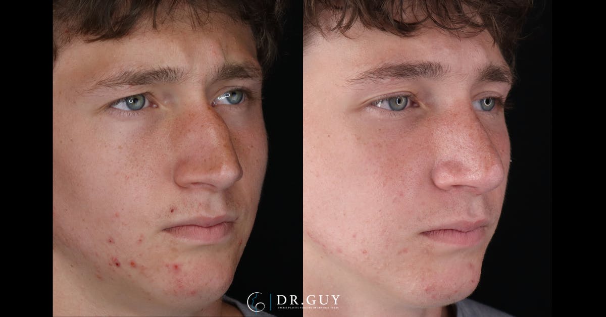 Surgical Rhinoplasty Before & After Gallery - Patient 345155 - Image 5