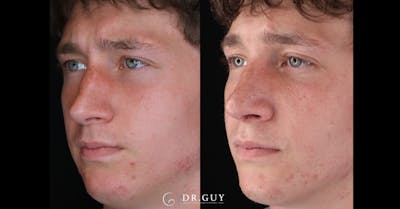 Surgical Rhinoplasty Before & After Gallery - Patient 345155 - Image 1