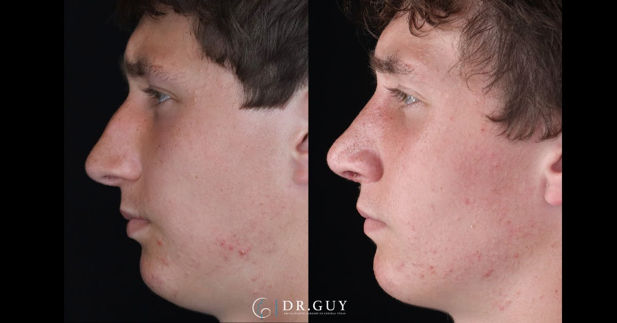 Surgical Rhinoplasty Before & After Gallery - Patient 345155 - Image 2