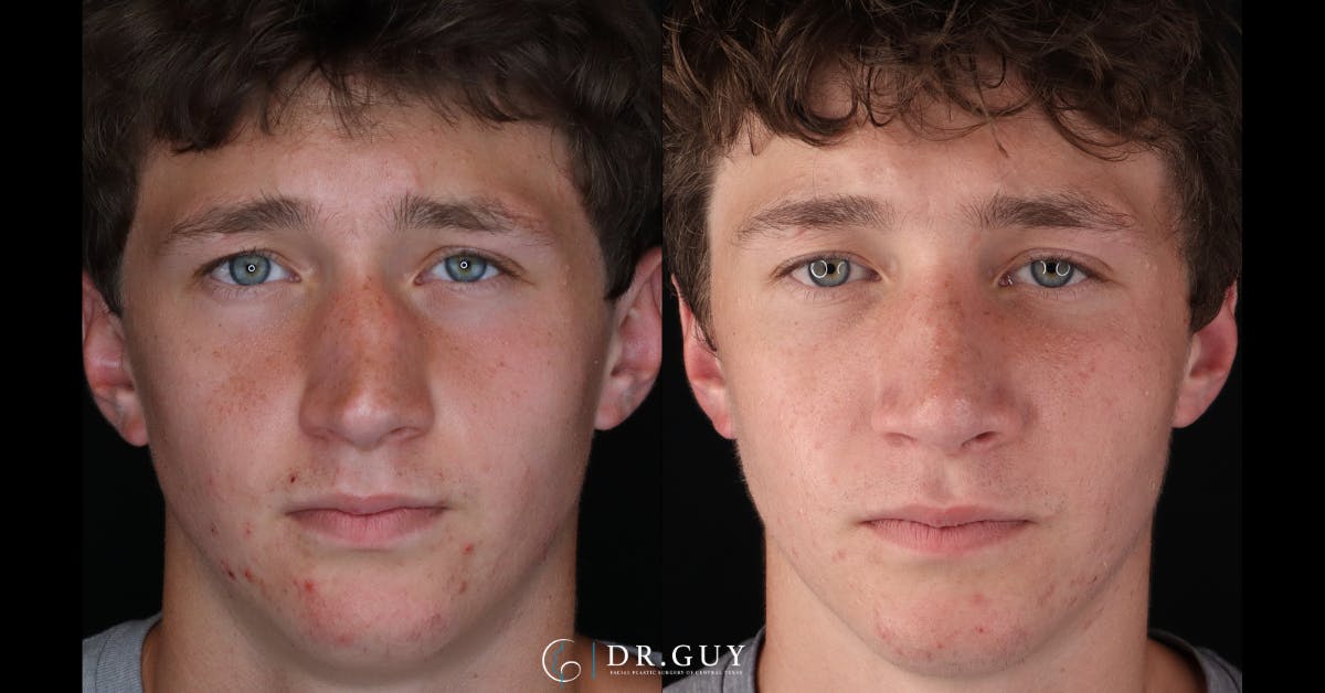 Surgical Rhinoplasty Before & After Gallery - Patient 345155 - Image 3