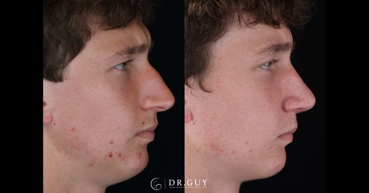 Surgical Rhinoplasty Before & After Gallery - Patient 345155 - Image 4