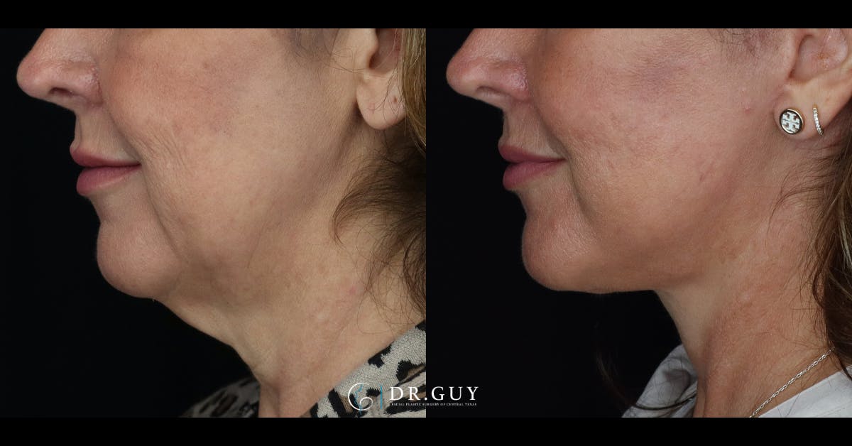 Facelift Before & After Gallery - Patient 765357 - Image 2
