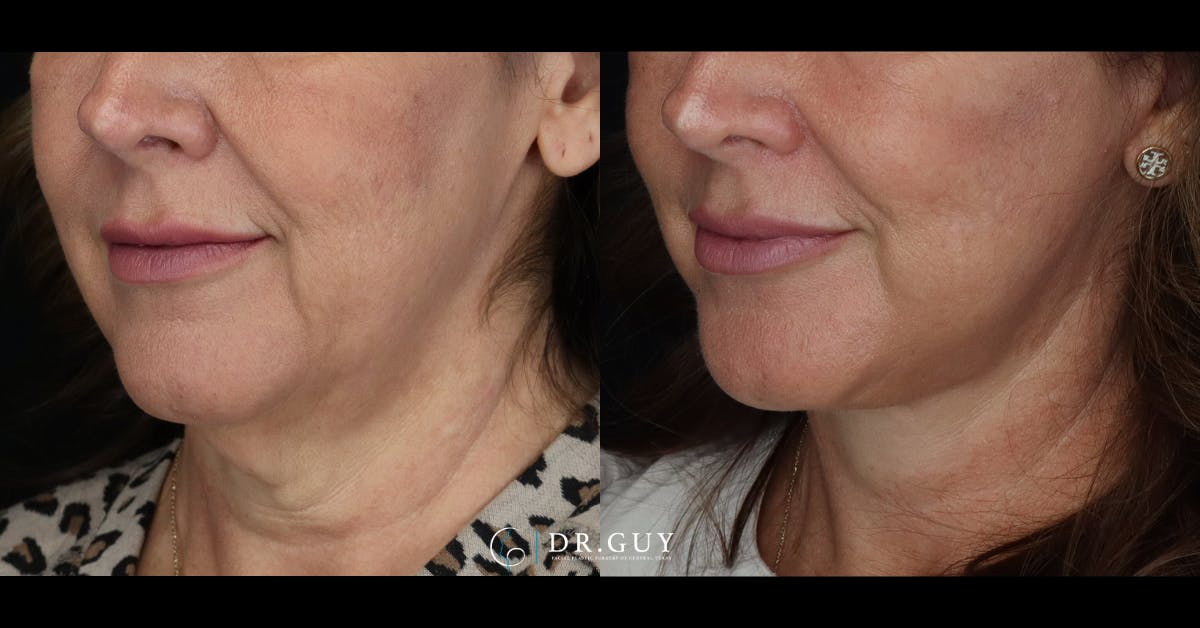 Facelift Before & After Gallery - Patient 765357 - Image 1