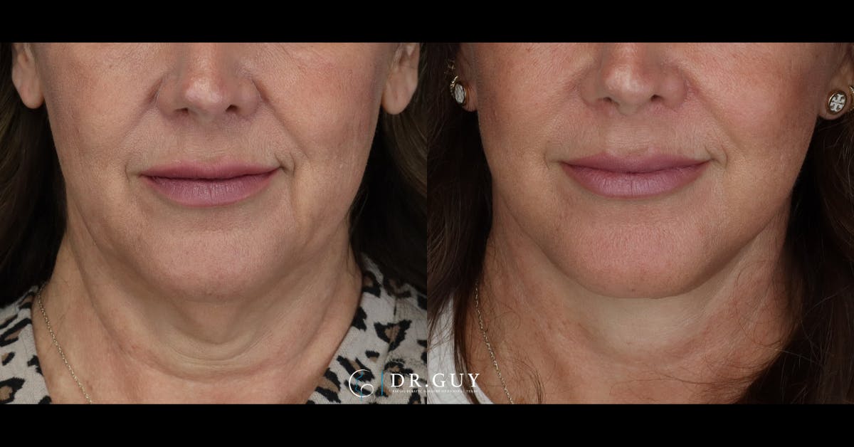 Facelift Before & After Gallery - Patient 765357 - Image 3