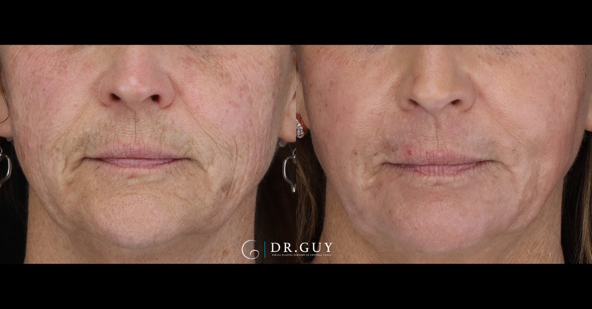 Laser Before & After Gallery - Patient 220756 - Image 2