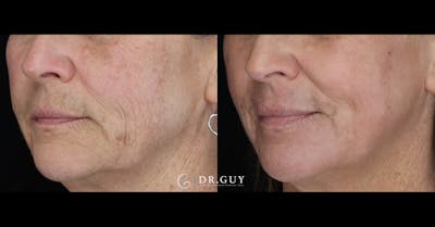Laser Before & After Gallery - Patient 220756 - Image 1