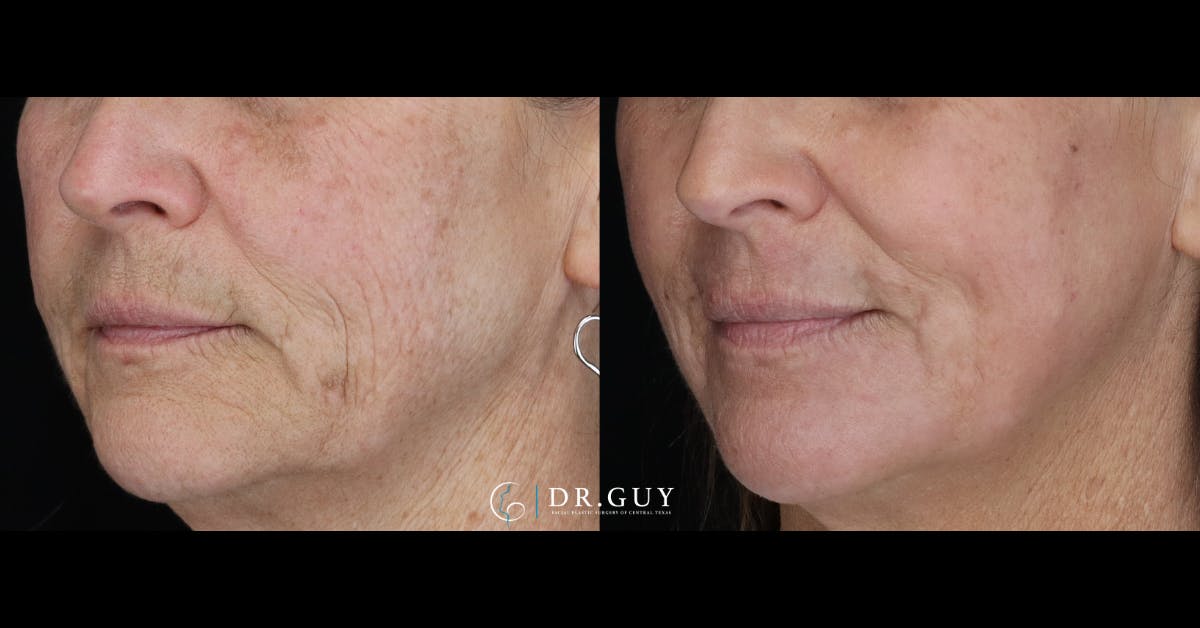 Laser Before & After Gallery - Patient 220756 - Image 1
