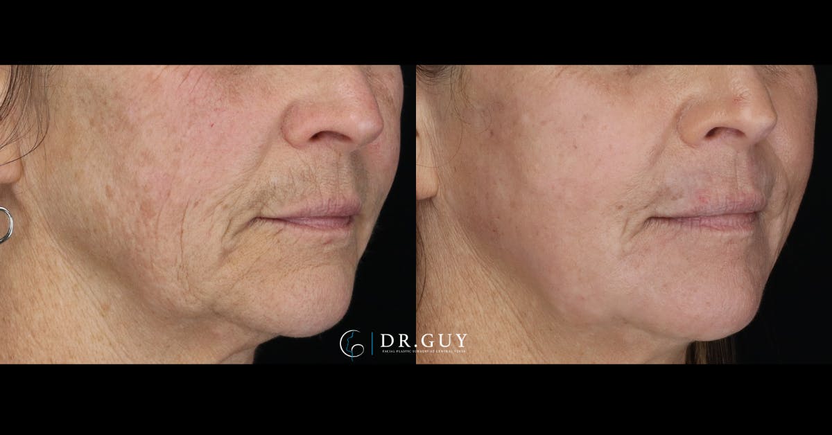 Laser Before & After Gallery - Patient 220756 - Image 3