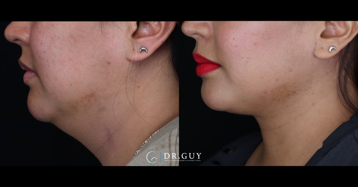 Neck Lift Before & After Gallery - Patient 145512 - Image 2