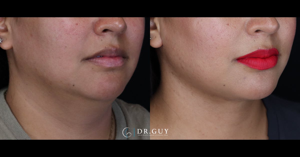 Neck Lift Before & After Gallery - Patient 145512 - Image 5