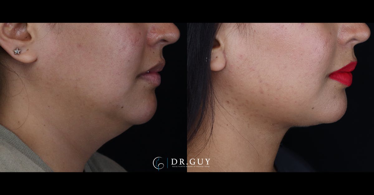 Neck Lift Before & After Gallery - Patient 145512 - Image 4