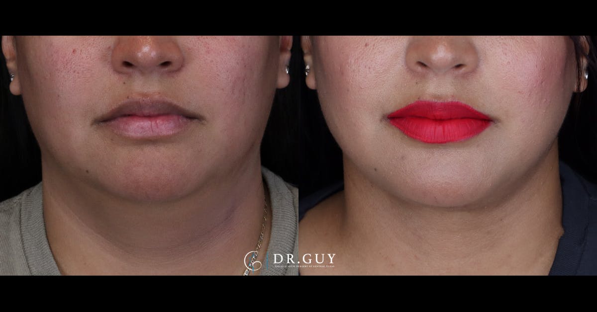 Neck Lift Before & After Gallery - Patient 145512 - Image 3
