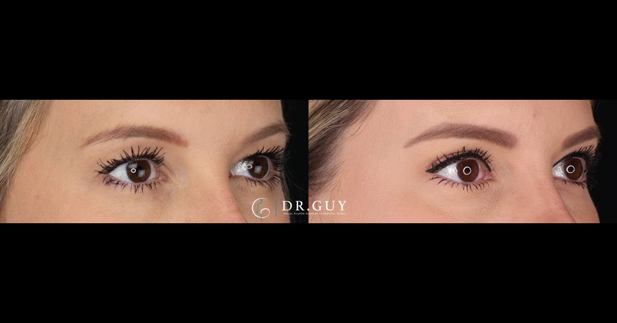 Upper Blepharoplasty Before & After Gallery - Patient 243644 - Image 2
