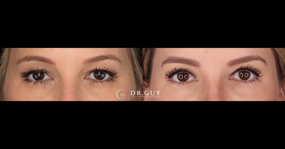 Upper Blepharoplasty Before & After Gallery - Patient 243644 - Image 1