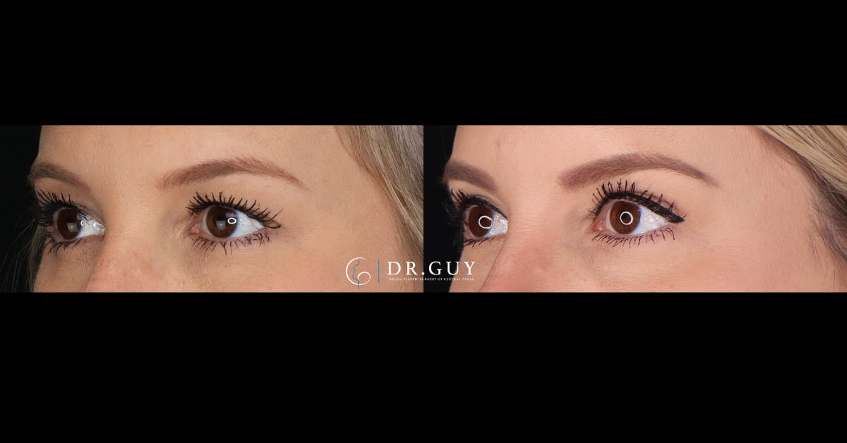 Upper Blepharoplasty Before & After Gallery - Patient 243644 - Image 3
