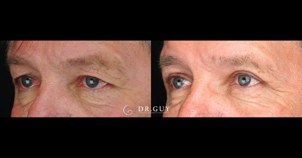 Upper Blepharoplasty Before & After Gallery - Patient 186630 - Image 2