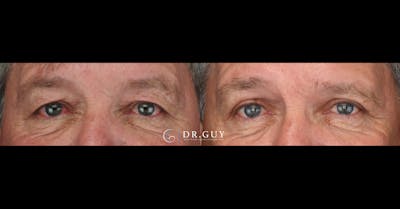Upper Blepharoplasty Before & After Gallery - Patient 186630 - Image 1