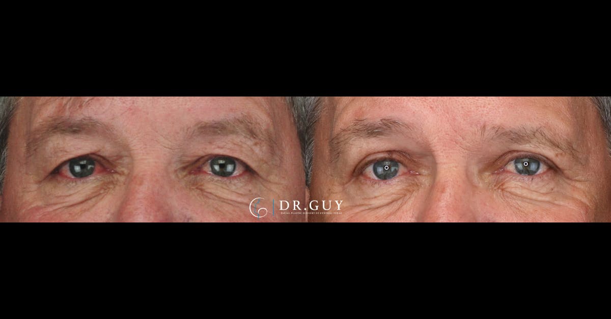 Upper Blepharoplasty Before & After Gallery - Patient 186630 - Image 1