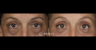 Lower Blepharoplasty Before & After Gallery - Patient 765357 - Image 1