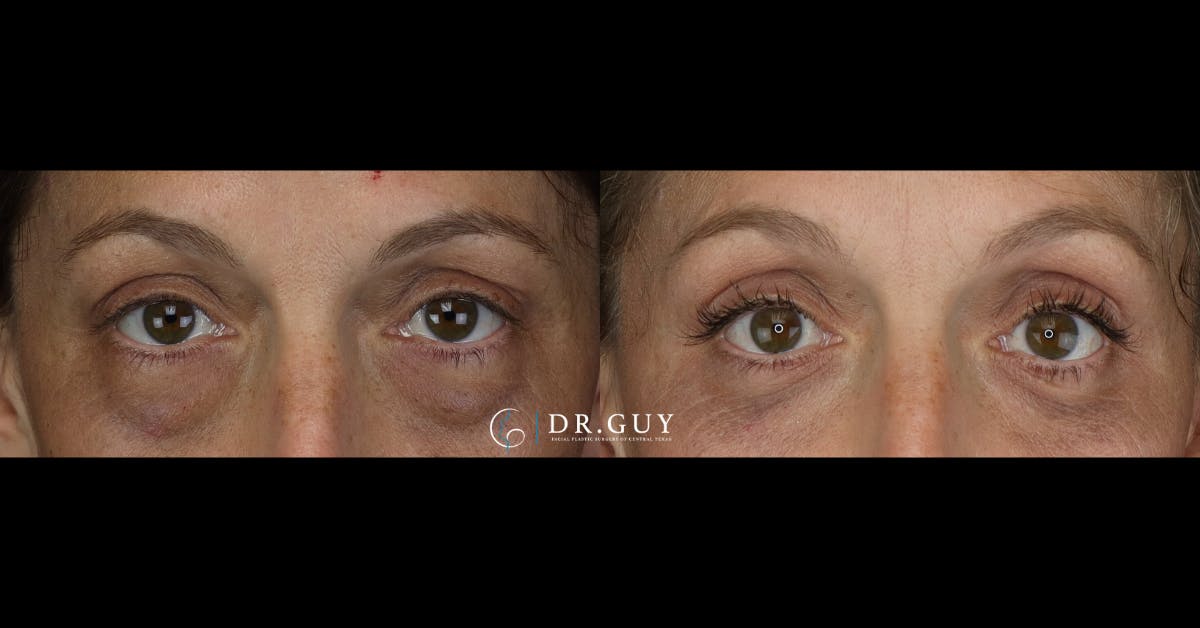 Lower Blepharoplasty Before & After Gallery - Patient 765357 - Image 1