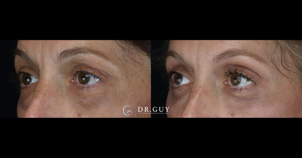 Lower Blepharoplasty Before & After Gallery - Patient 765357 - Image 2