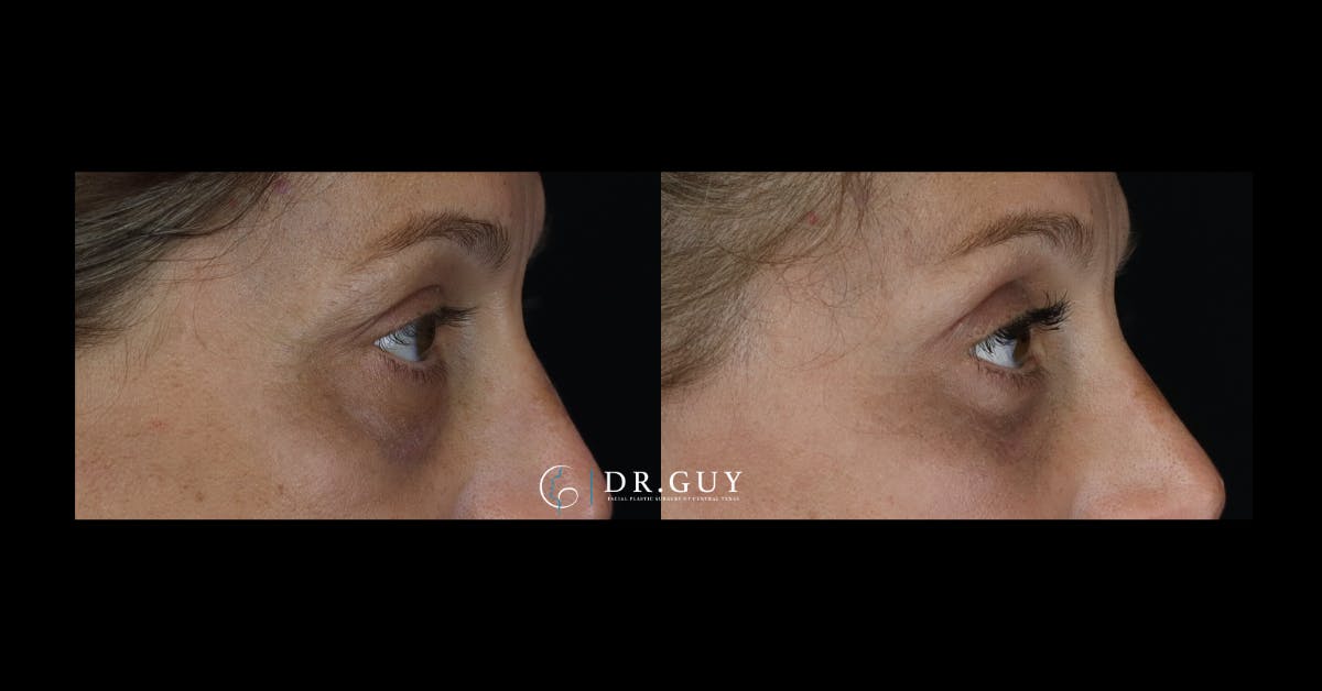 Lower Blepharoplasty Before & After Gallery - Patient 765357 - Image 3