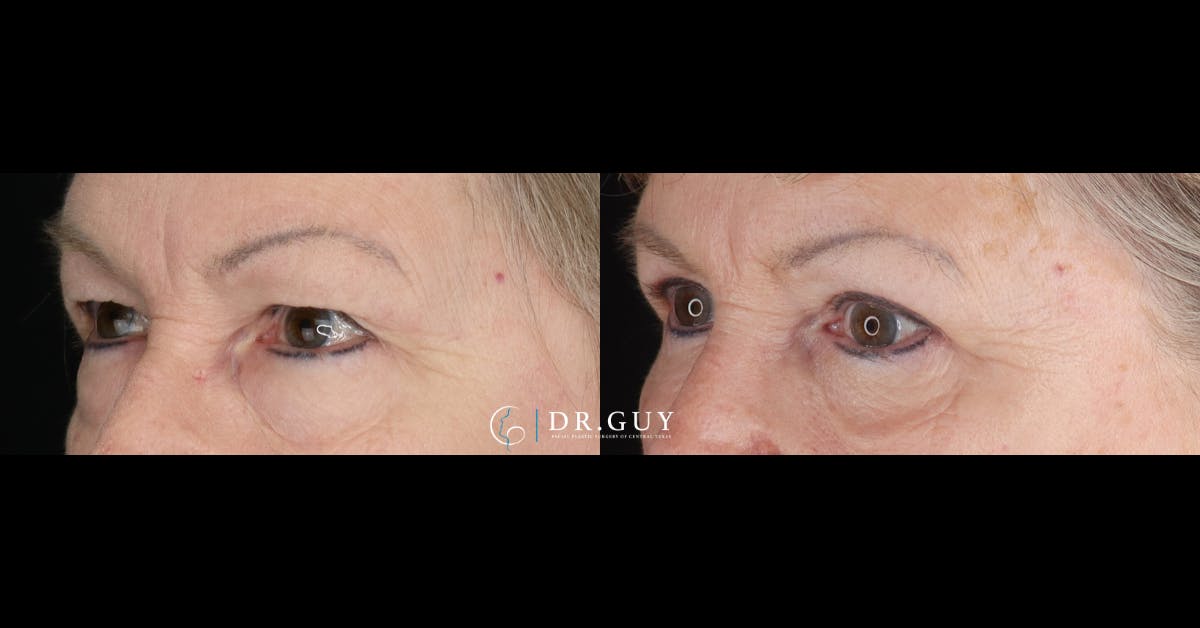 Lower Blepharoplasty Before & After Gallery - Patient 400904 - Image 2