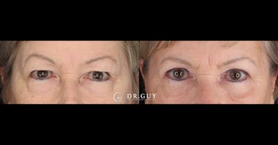 Upper Blepharoplasty Before & After Gallery - Patient 427775 - Image 1