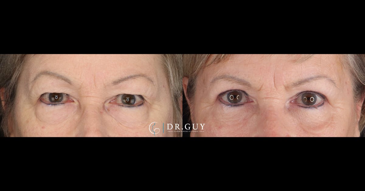 Lower Blepharoplasty Before & After Gallery - Patient 400904 - Image 1