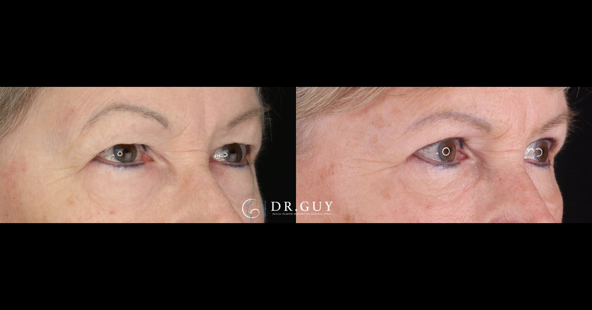 Lower Blepharoplasty Before & After Gallery - Patient 400904 - Image 3