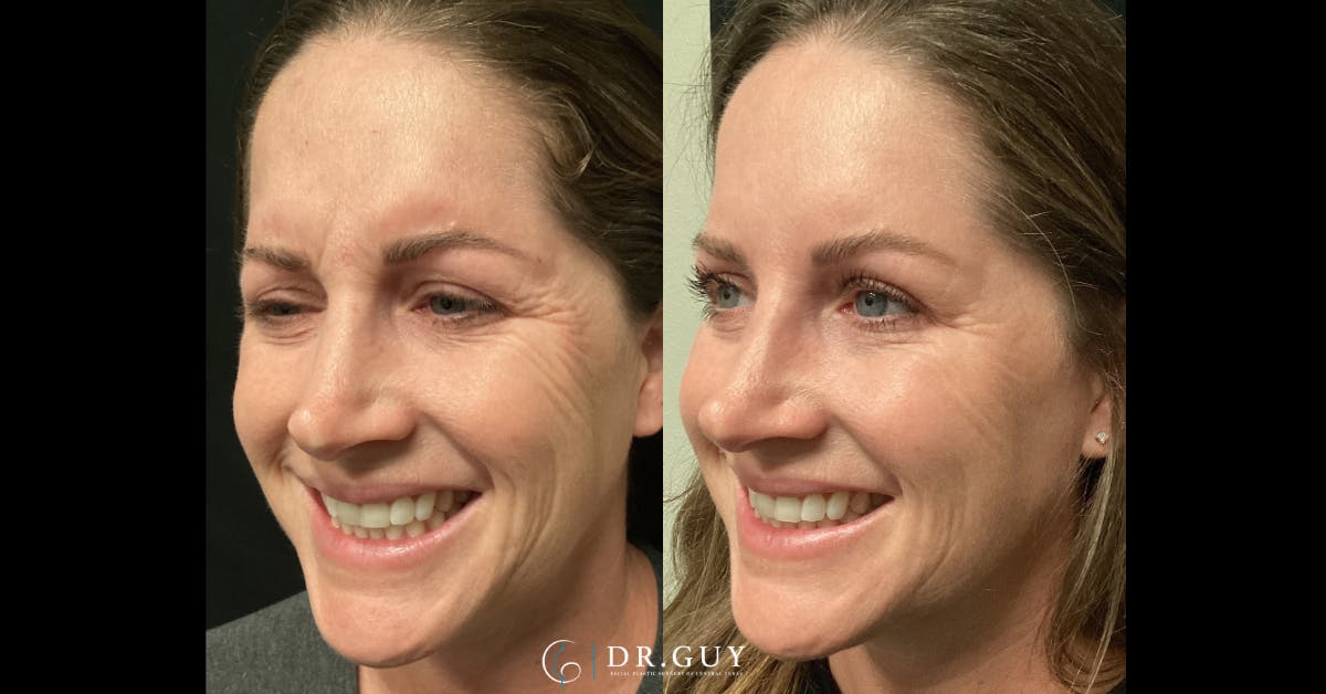 Neuromodulators Before & After Gallery - Patient 532720 - Image 2