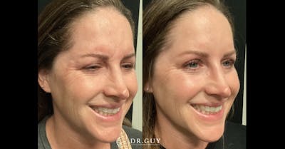 Fillers Before & After Gallery - Patient 863606 - Image 1