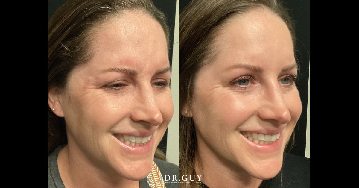 Neuromodulators Before & After Gallery - Patient 532720 - Image 1