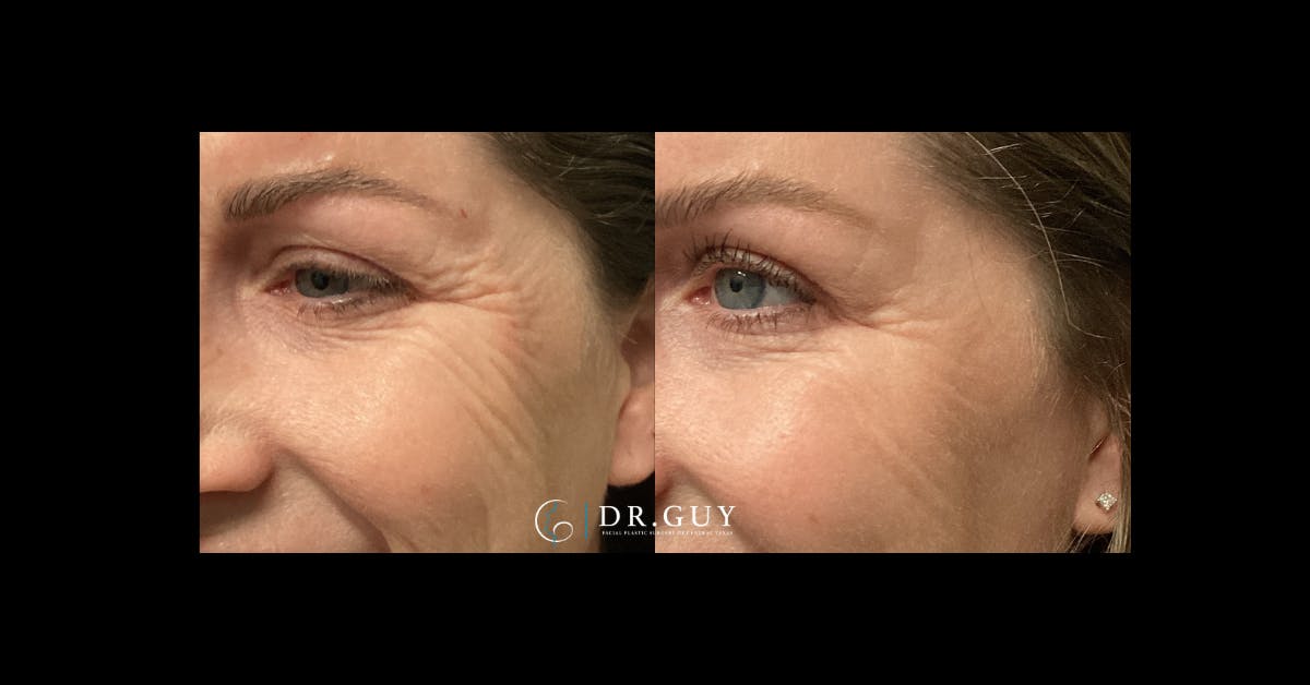 Neuromodulators Before & After Gallery - Patient 532720 - Image 3