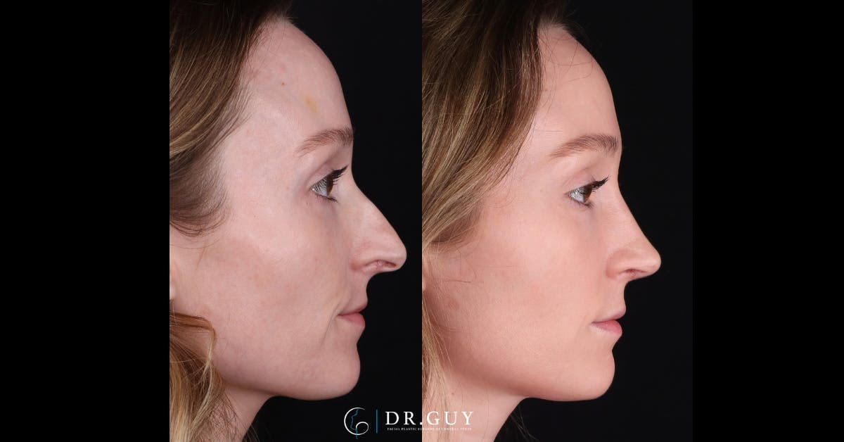 Surgical Rhinoplasty Before & After Gallery - Patient 285788 - Image 5