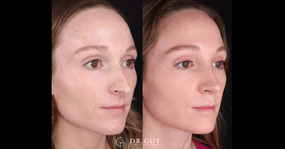 Surgical Rhinoplasty Before & After Gallery - Patient 285788 - Image 4