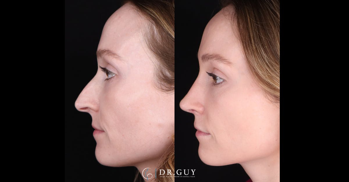 Surgical Rhinoplasty Before & After Gallery - Patient 285788 - Image 2