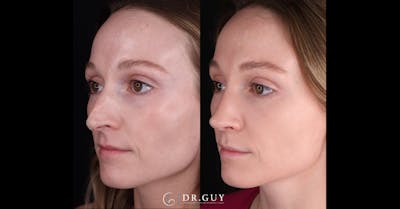 Surgical Rhinoplasty Before & After Gallery - Patient 285788 - Image 1