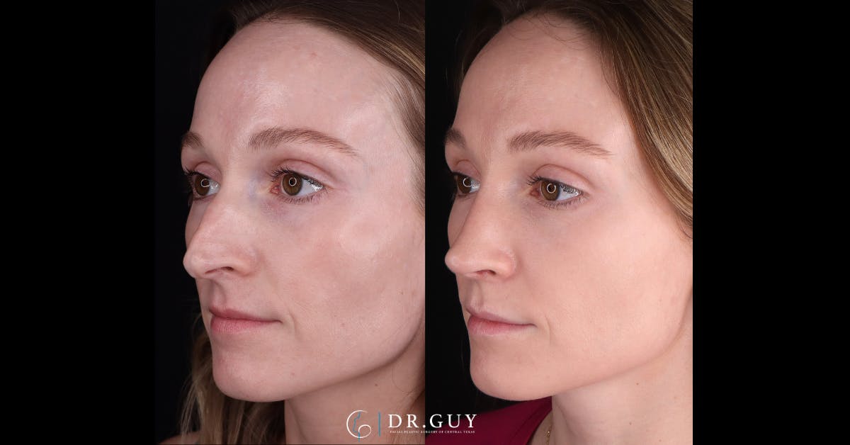 Surgical Rhinoplasty Before & After Gallery - Patient 285788 - Image 1