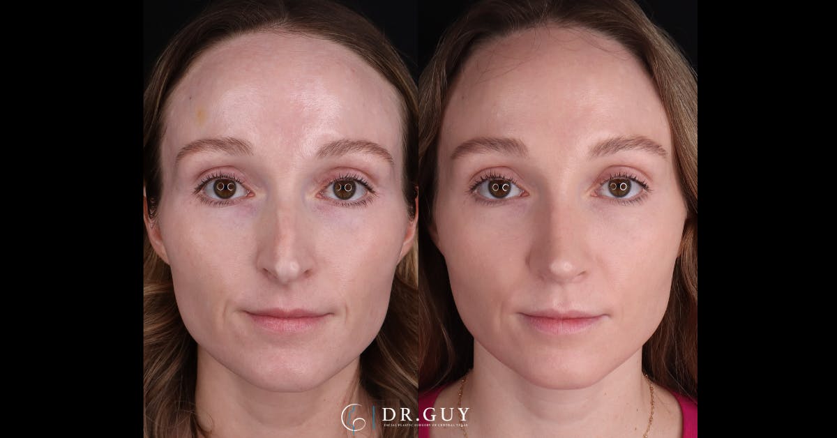 Surgical Rhinoplasty Before & After Gallery - Patient 285788 - Image 3
