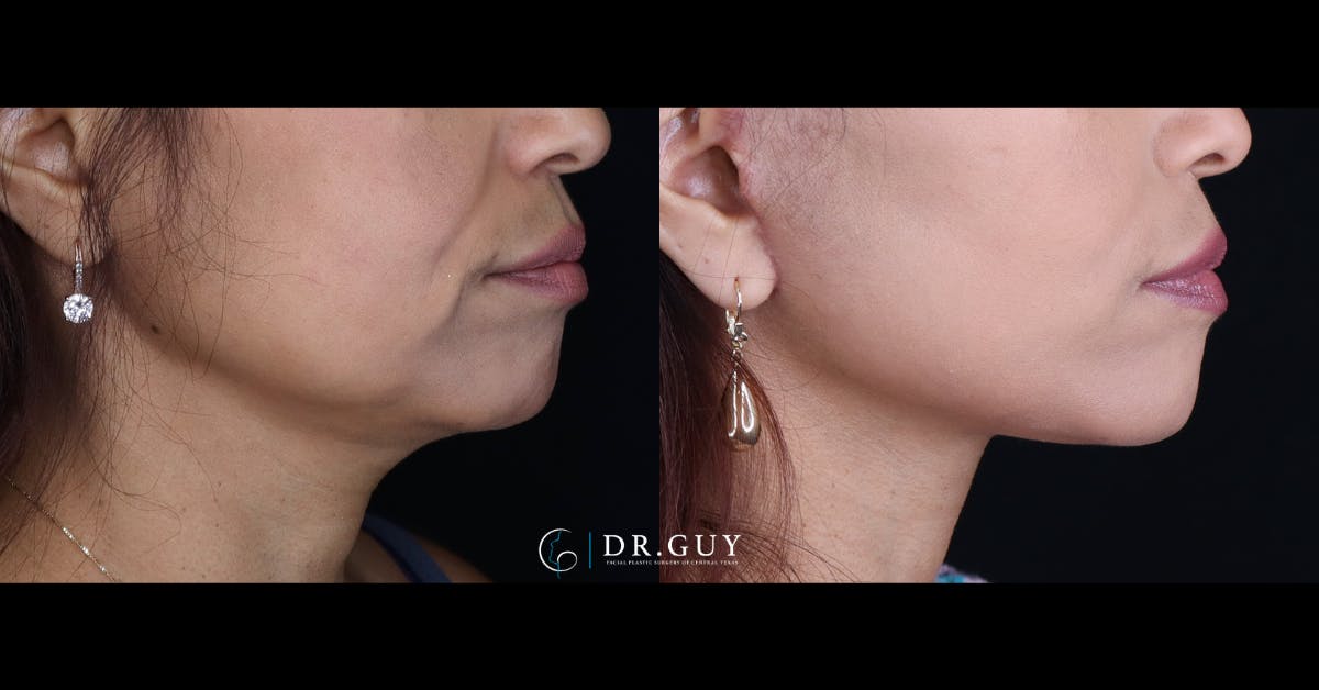 Mini Facelift Before & After Gallery - Patient 391598 - Image 4