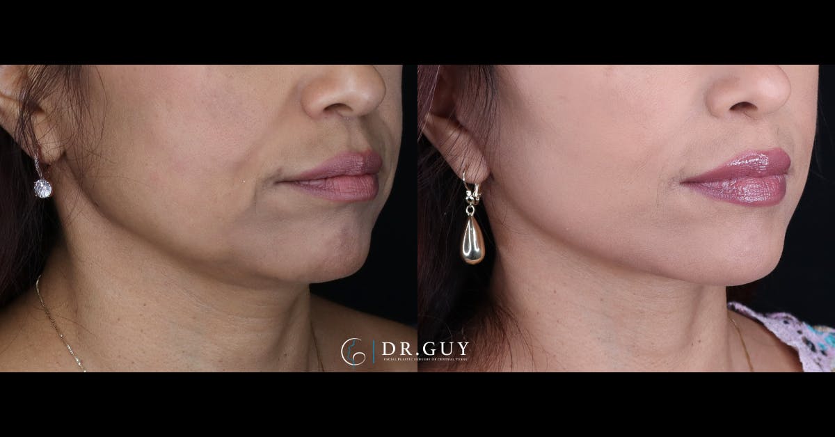Mini Facelift Before & After Gallery - Patient 391598 - Image 3