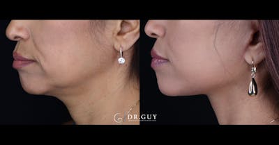 Mini Facelift Before & After Gallery - Patient 391598 - Image 1