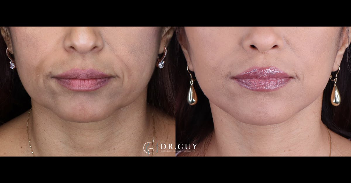 Mini Facelift Before & After Gallery - Patient 391598 - Image 2