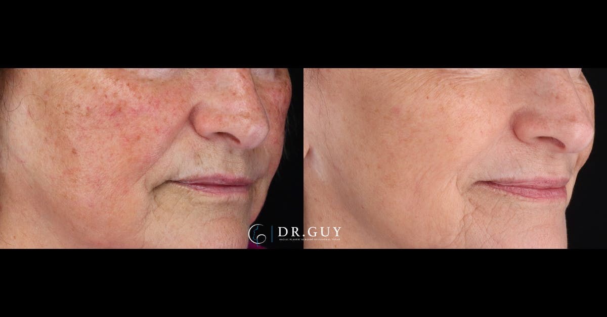 Laser Before & After Gallery - Patient 116711 - Image 3